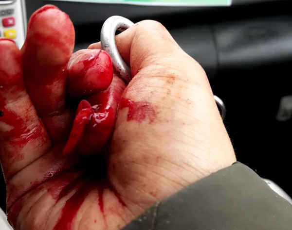 Ngón tay trỏ bị dập nát sau khi bị hành hung. Ảnh: laodong.com.vn