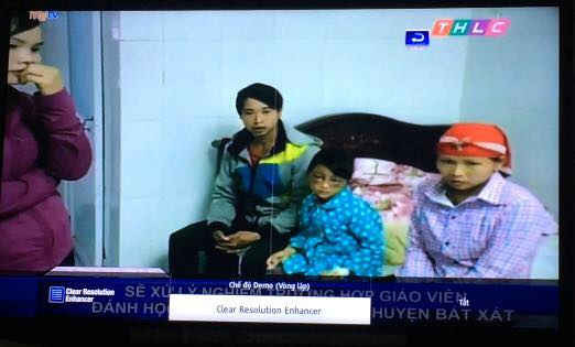 Bé gái Phàn Chung Thủy học sinh lớp 3 trường tiểu học xã Phìn Ngan (huyện Bát Xát) bị cô giáo đánh tím mặt (người giữa ảnh) đang điều trị tại Bệnh viên đa khoa huyện Bát Xát (tỉnh Lào Cai). Ảnh của Đài PTTH Lào Cai  