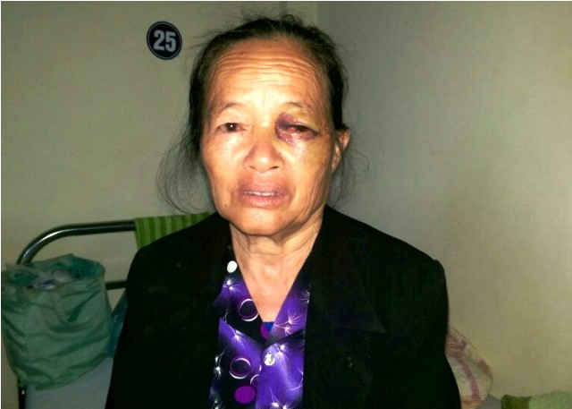 Vợ ông Mão bị PCT xã Xuân Dương dùng dùi cui đánh vào mặt gây thương tích nặng