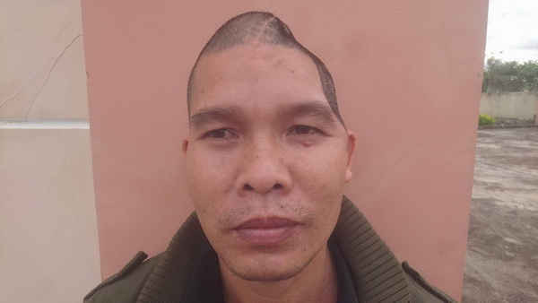 Phần đầu móp vào sau phẫu thuật của ông Trần Văn Thanh - nạn nhân bị chém thương tật vĩnh viễn 90% của bảo vệ công ty Long Sơn.