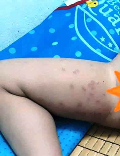 Một bé trai bị nổi mẩn đỏ ở bẹn do tắm biển