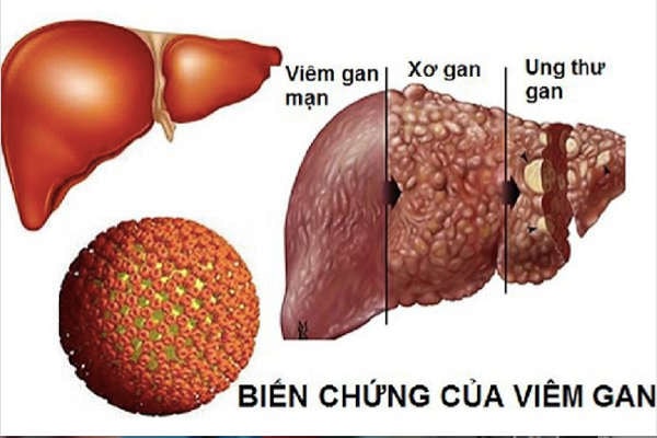 viem gan b lay lan nhanh hon hiv gap 100 lan