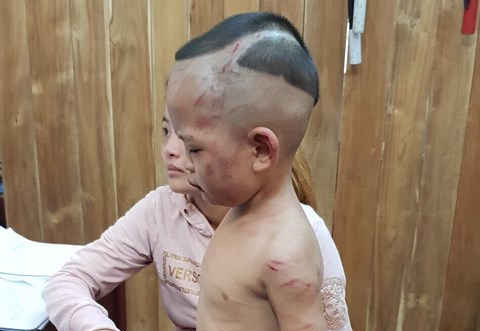 Kiên Giang: Bé trai 3 tuổi bị cha dượng bạo hành dã man