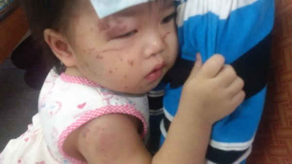 Gia Lai: Một em bé bị nhiều vết thương bất thường khi đi nhà trẻ