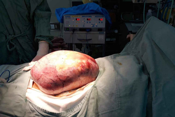 Phẫu thuật khối u buồng trứng "khổng lồ" cho cô gái trẻ