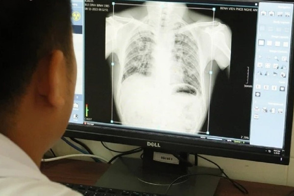 Nghệ An: Phát hiện thêm hàng loạt công nhân bị bệnh bụi phổi