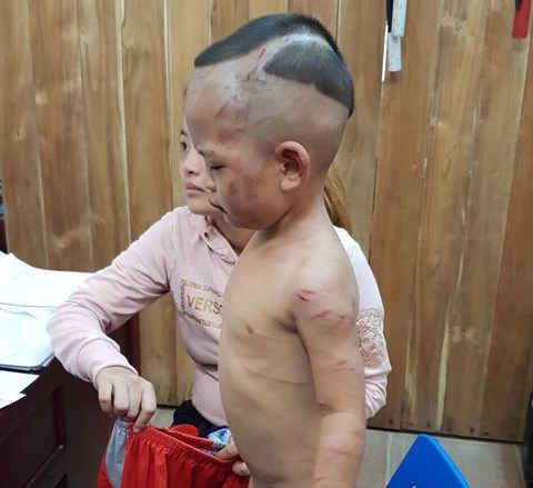 Kiên Giang: Bé trai 3 tuổi bị cha dượng bạo hành dã man